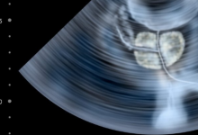 研究人員說BRCA2基因缺陷不僅是女性患癌癥的風(fēng)險(xiǎn)