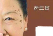 日常生活:怎樣祛除老年斑多種方法