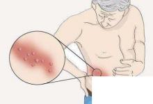 日常生活:纏腰龍到底是什么東西流傳腰上長一圈就壽命已盡