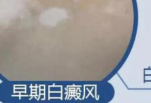 日常生活：怎樣區(qū)別是不是白癩風(fēng)