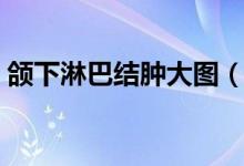 頜下淋巴結(jié)腫大圖（頜下淋巴結(jié)腫大嚴重嗎）